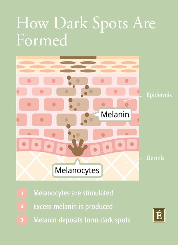 Infographic on how dark spots are formed